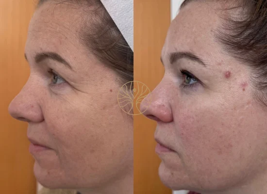 Microneedling before and after result at AETÉ Skin Ritual in Marylebone, image 6