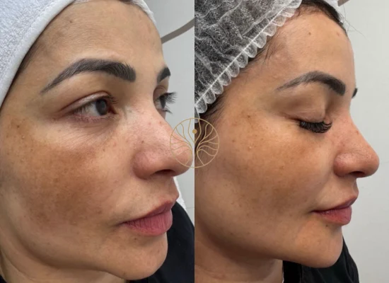 Microneedling before and after result at AETÉ Skin Ritual in Marylebone, image 4