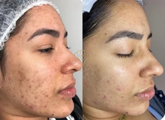 Microneedling before and after result at AETÉ Skin Ritual in Marylebone, image 3