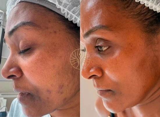 Microneedling before and after result at AETÉ Skin Ritual in Marylebone, image 2