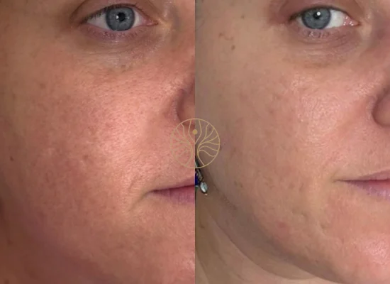 Microneedling before and after result at AETÉ Skin Ritual in Marylebone, image 1