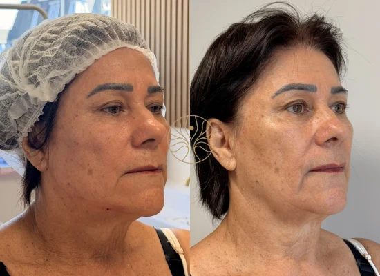 Chin filler before and after result at AETÉ Skin Ritual in Marylebone, client result 2