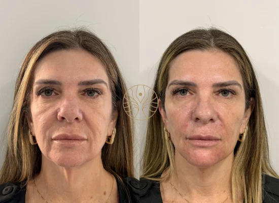 Chin filler before and after result at AETÉ Skin Ritual in Marylebone, client result 1