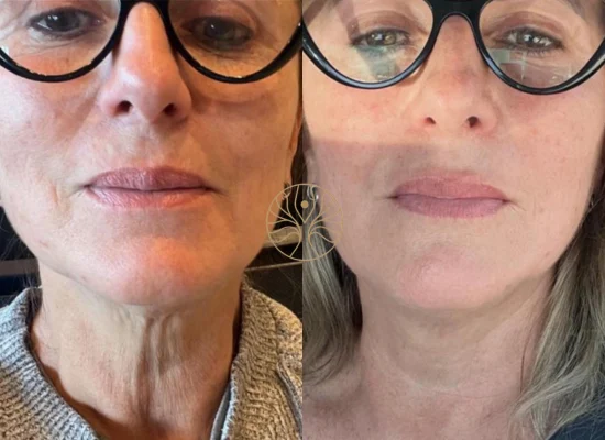 Gouri before and after result 1 at AETÉ Skin Ritual Marylebone