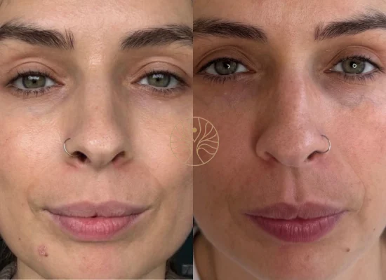 Gouri before and after result 2 at AETÉ Skin Ritual Marylebone