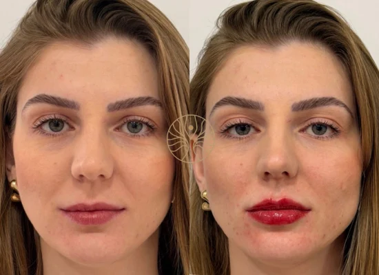 Natural-looking lip filler result in Marylebone, London
