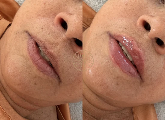 Adult client lip filler result at AETÉ Skin Ritual in Marylebone