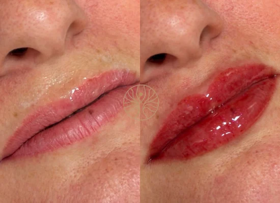 Personalised lip enhancement result at AETÉ Skin Ritual