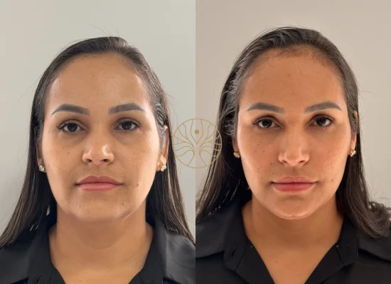 Profhilo before and after result at AETÉ Skin Ritual in Marylebone, client result 2