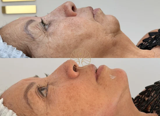 Profhilo before and after result at AETÉ Skin Ritual in Marylebone, client result 3