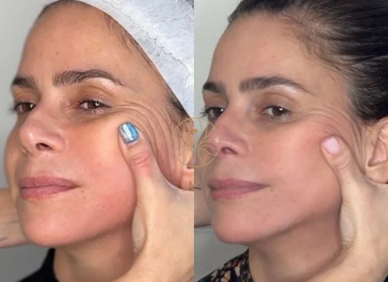 Radiesse before and after result 5 at AETÉ Skin Ritual Marylebone