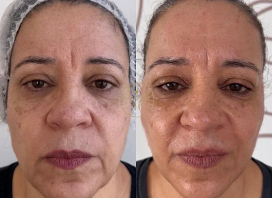 Radiesse before and after result 4 at AETÉ Skin Ritual Marylebone